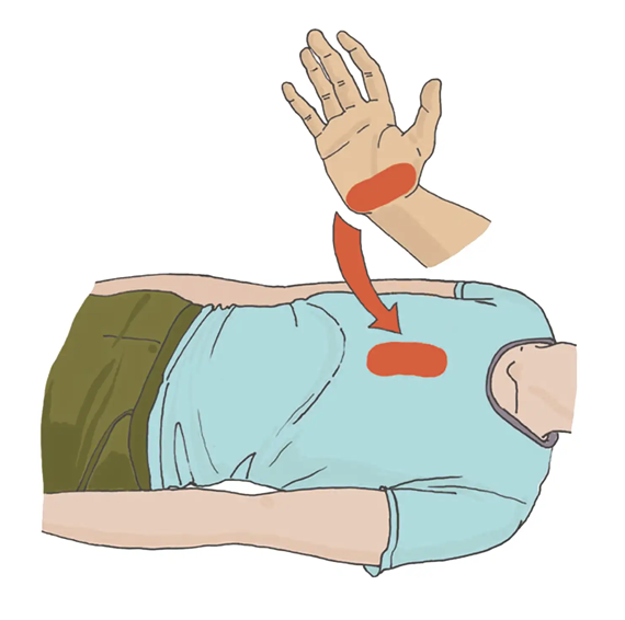 Расположение ладони на грудной клетке при СЛР